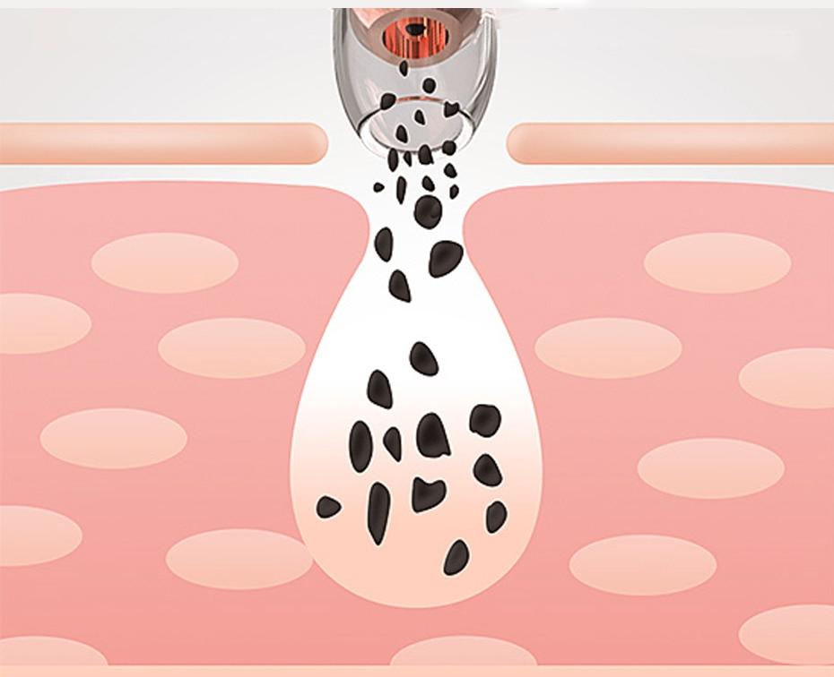 Blackhead Remover Vacuum Cleaner - EZdeels