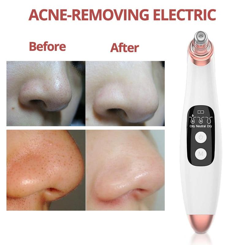 Pore Cleaner Face Skin Care Tool - EZdeels