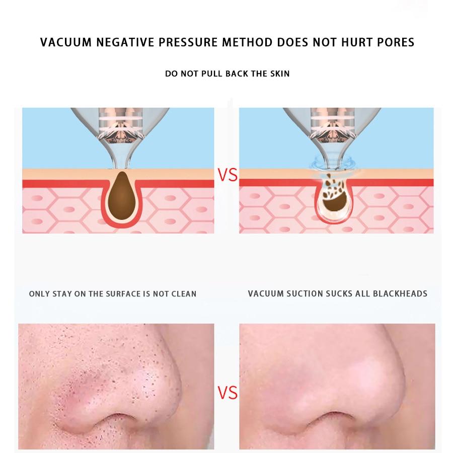 Blackhead Remover Vacuum Cleaner - EZdeels