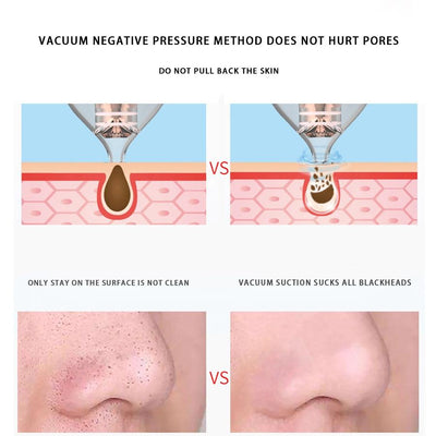 Blackhead Remover Vacuum Cleaner - EZdeels